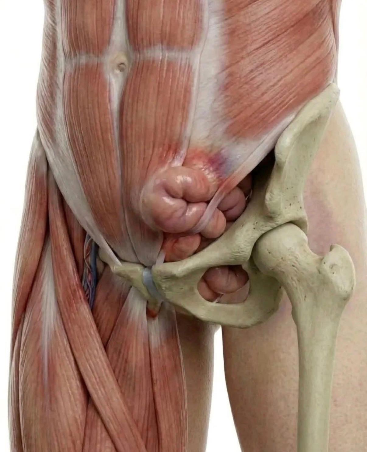 Hernias