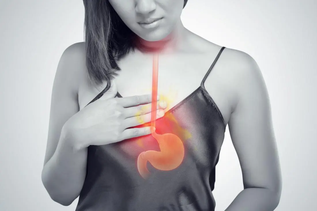 Acid Reflux